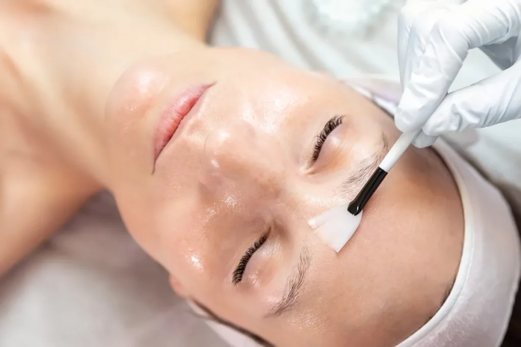 Chemical Peels Treatment in Lubbock, TX at Beyond Aesthetics