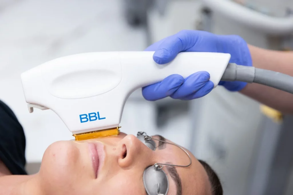 Forever Clear BBL® by Sciton in Lubbock, TX at Beyond Aesthetics