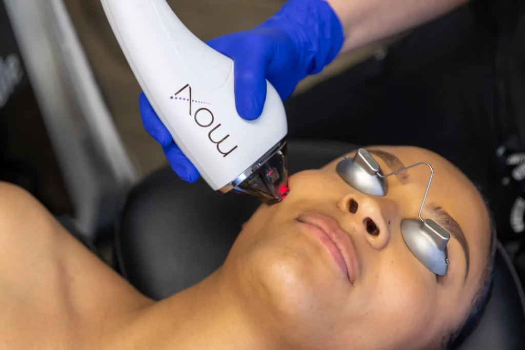 MOXI® laser by Sciton in Lubbock, TX at Beyond Aesthetics