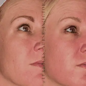 Before and After treatment results at Beyond Aesthetics in Lubbock, TX